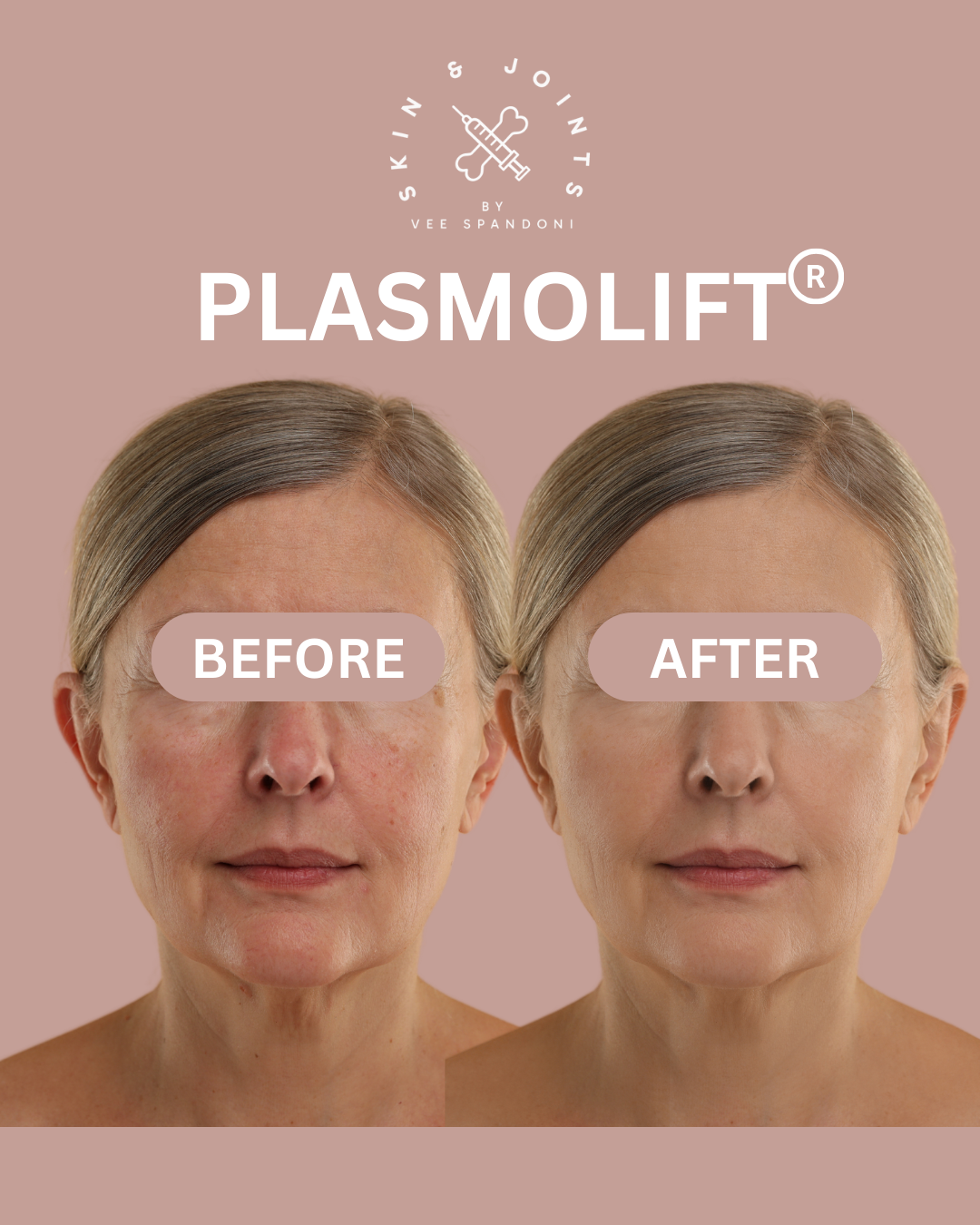 non surgical face rejuvenation with plasmolift