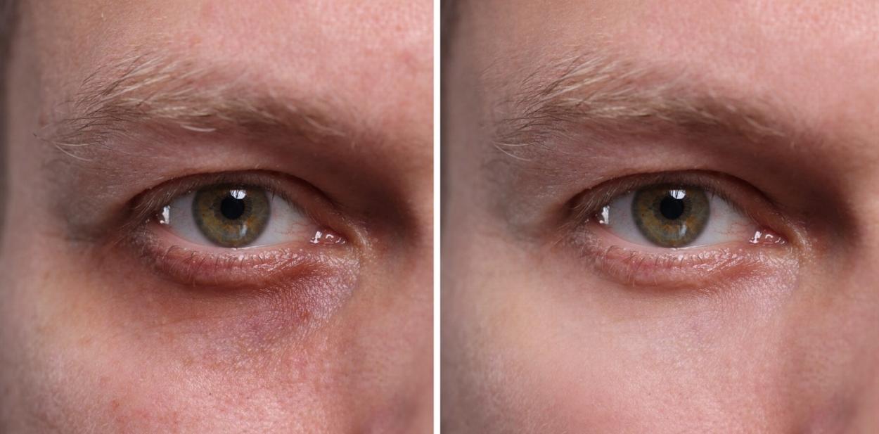 Dark circles treatment