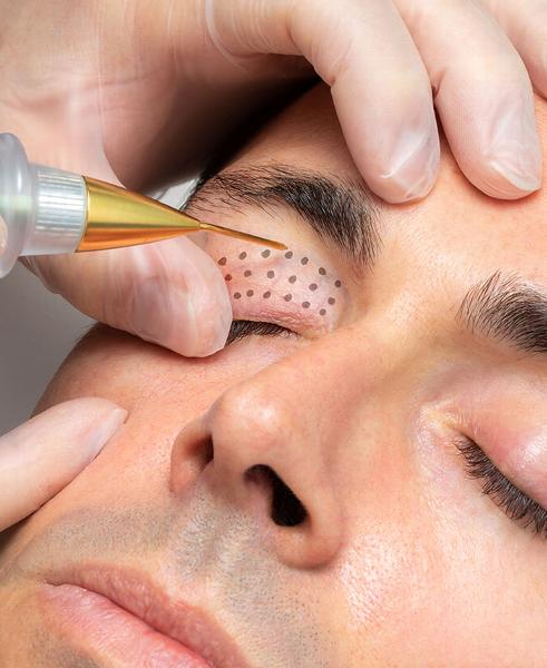 man receiving fibroblasts treatment to eyelid