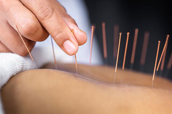 Acupuncture in lower back