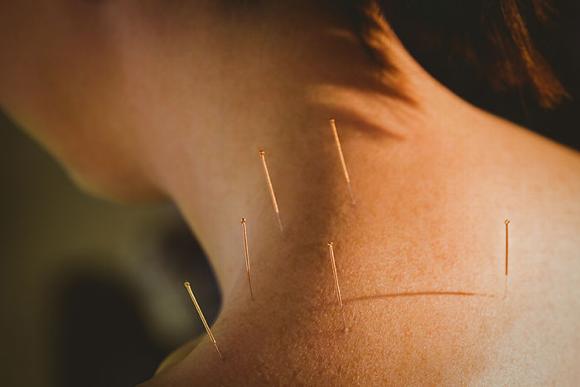 Acupuncture in shoulder